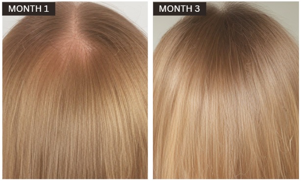 hair loss treatment case study women Hr23+