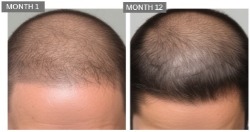 male hair loss case studies 