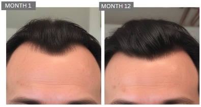 Male hair loss case studies 