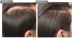 Male hair loss case studies 