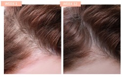 female hair loss case study 