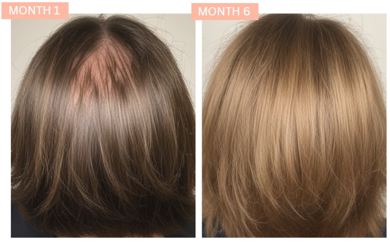 hair growth after HR23+ female photo 