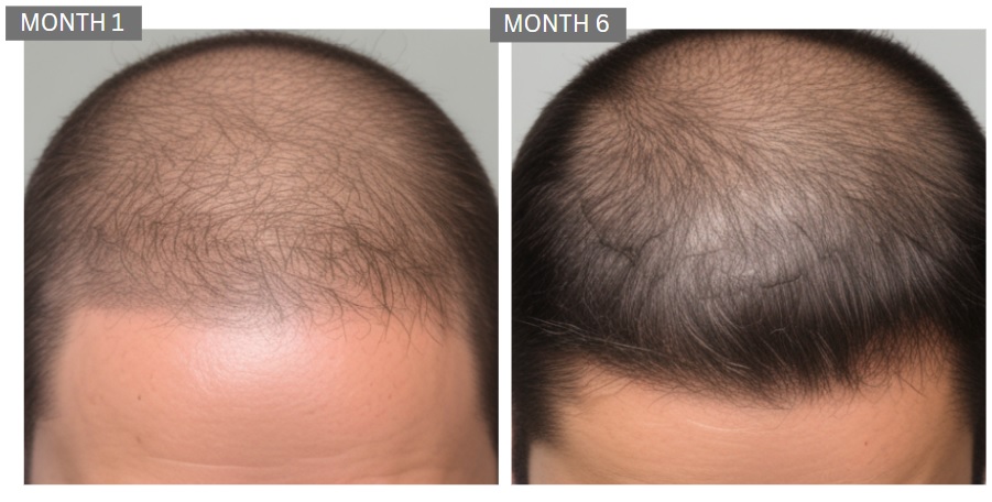 male hair loss before and after photos study