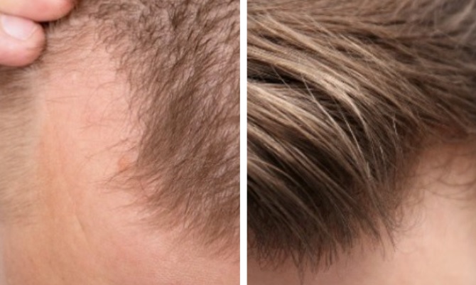 HR23+ hair loss treatment before and after review 