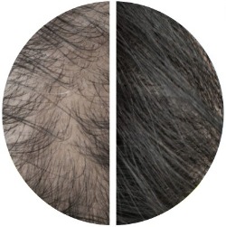 female hair loss treatment before and after review 