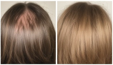 female hair loss case studies HR23+