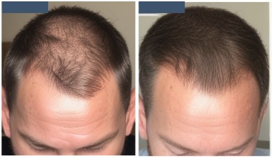 male hair loss case studies HR23+