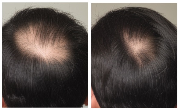 hair regrowth at the crown region before after photos