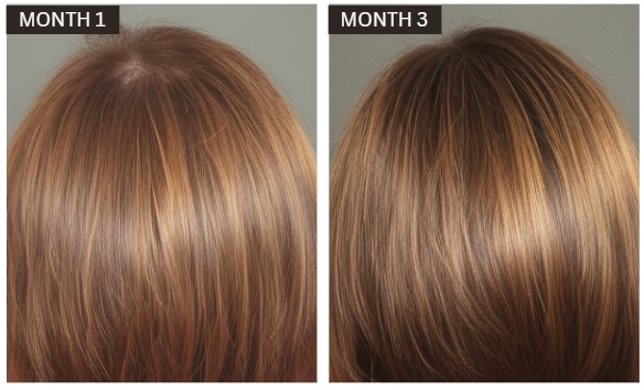 hair loss at the crwon before and after hair regrowth 