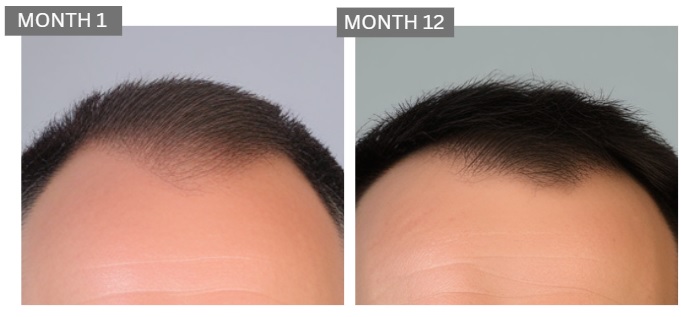 hair growth case study man 44