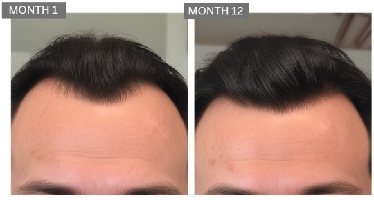 male hair loss treatment case study before after 12 months 