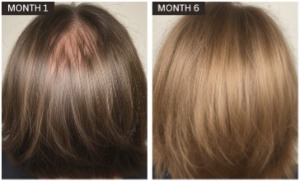 case study women hair loss 