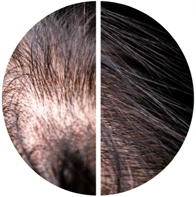 HR23+ hair loss treatment review before after 